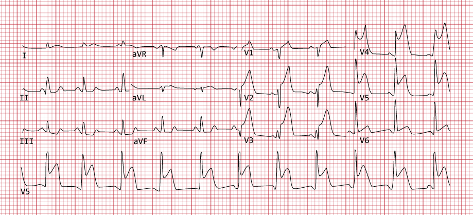 anterolateral ST elevation myocardial infarction
