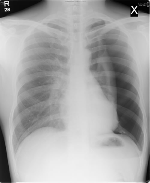 CXR L pneumothorax