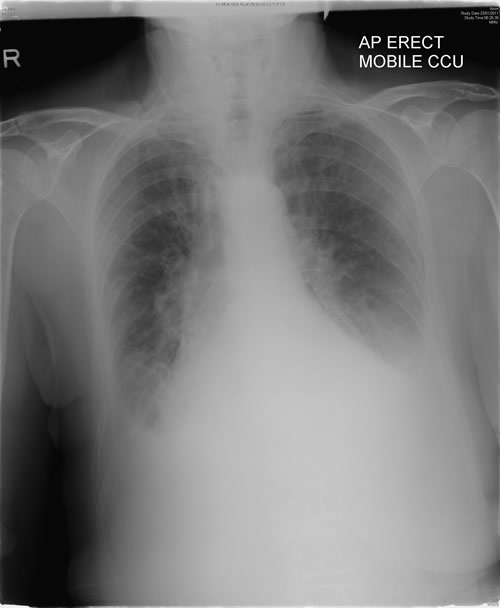 CXR Pulmonary oedema