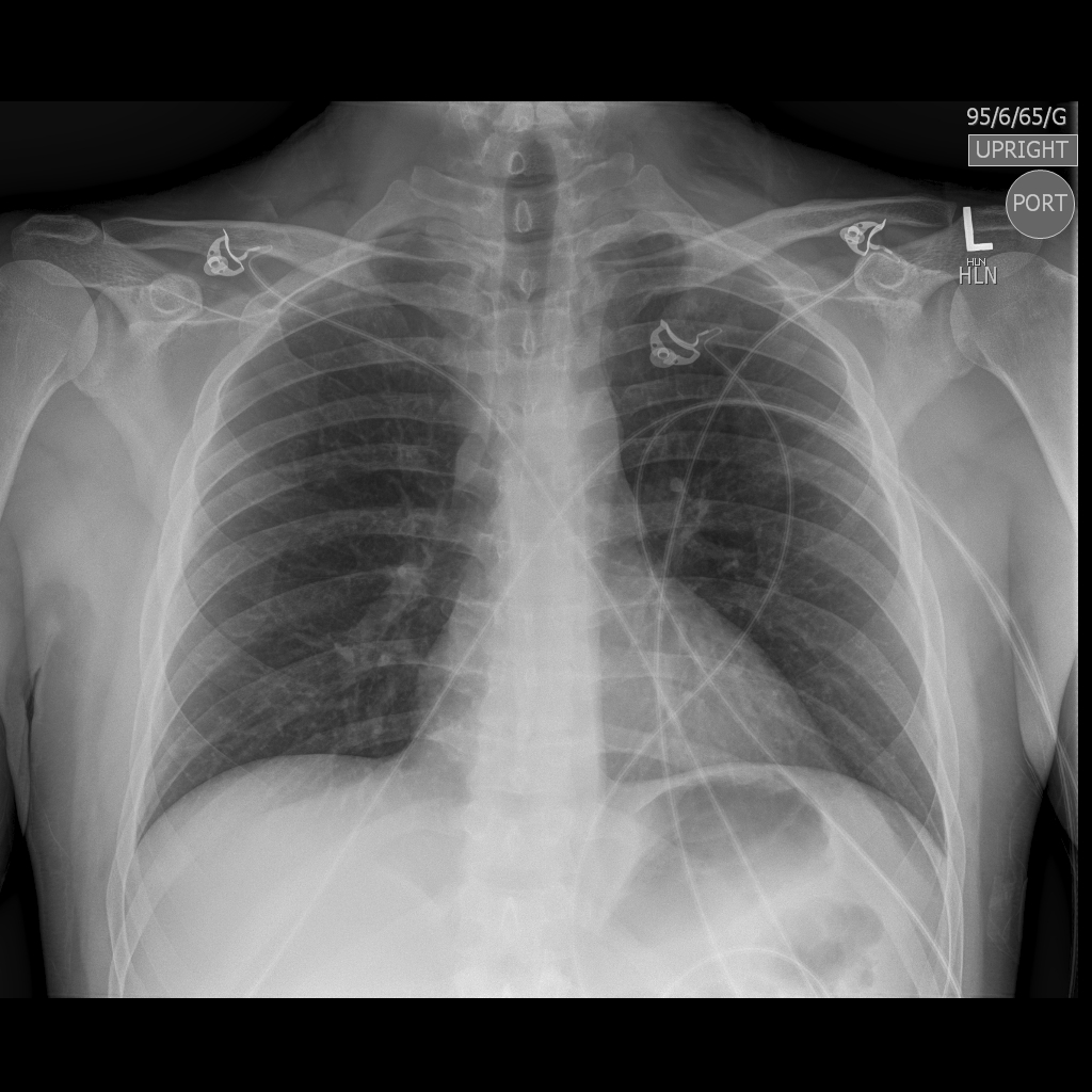 Plain AP chest X-ray with visible ECG leads
