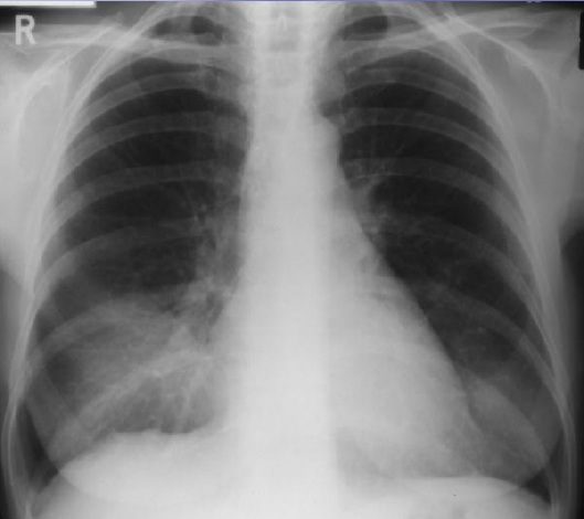 CXR aspiration pneumona