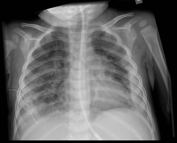 x-ray