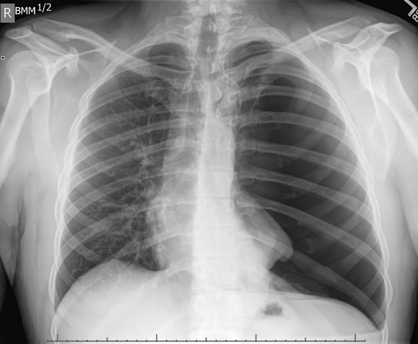x-ray